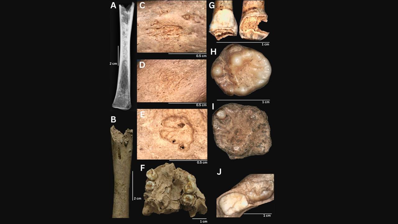 Vietnam Çocuk Frengi Benzeri Hastalık